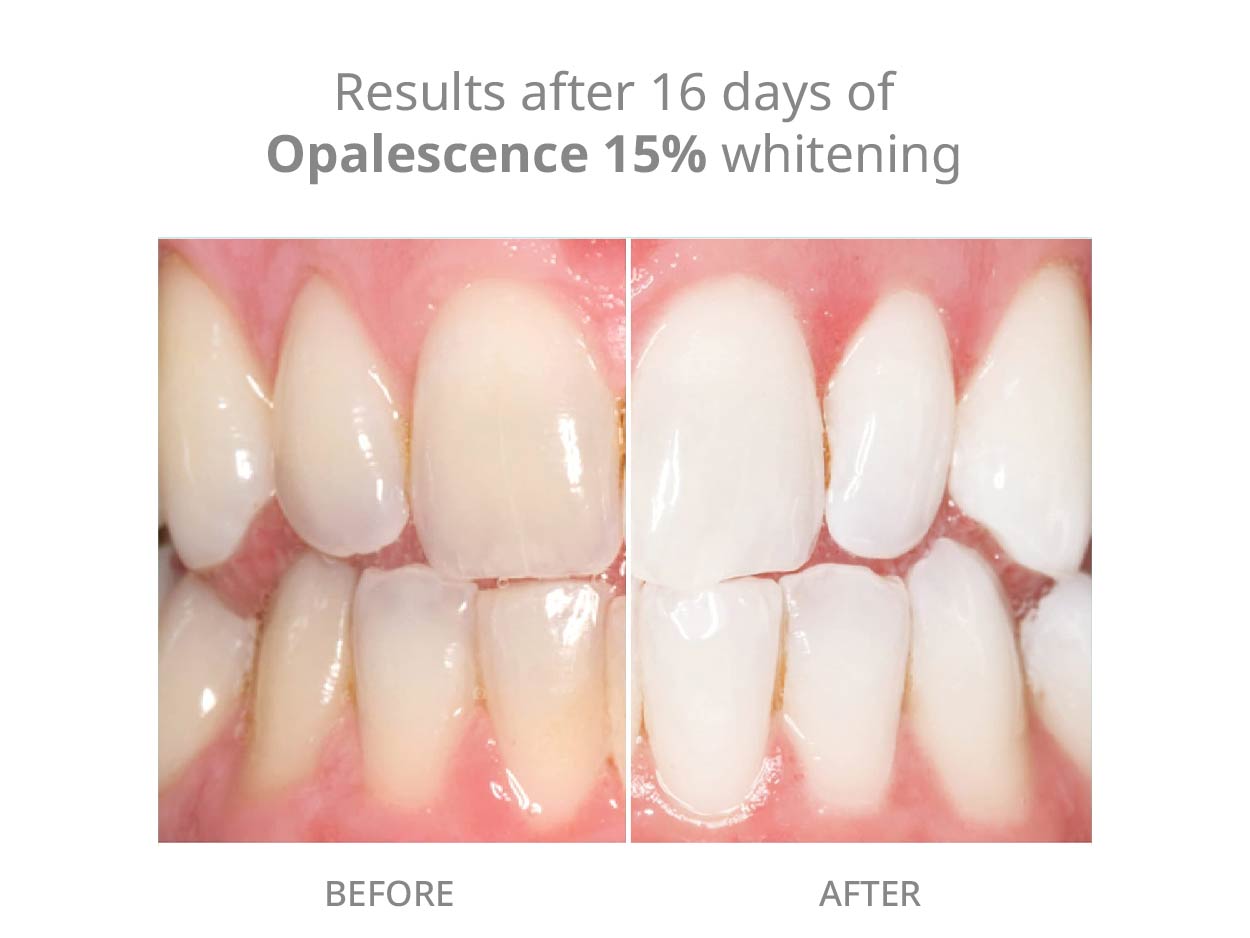 Opalescence 35% Teeth Whitening Gel Refill Syringes (8ct) - 5197-4