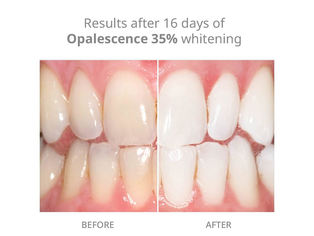 Opalescence 35% Teeth Whitening Gel Refill Syringes (8ct) - 5197-4