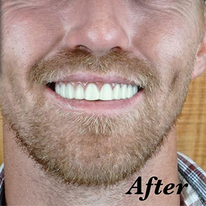 Professional Cosmetic Upper - New from Instant Smile! Hand Crafted Detail, Custom fit at Home! Works Best in Medium to Large Sized Mouths.