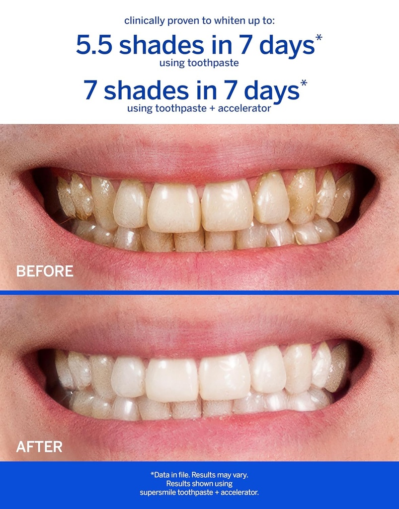 supersmile-professional-teeth-whitening--3.jpg